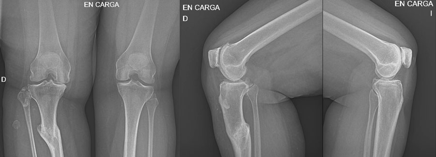 Post-traumatic knee pain: How to treat double varus deformity?