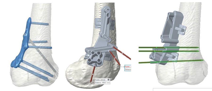 Femoral derotation osteotomy