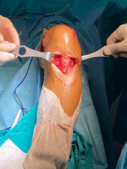 Tibial tubercule medialisation