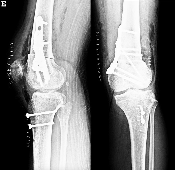 Post-op X-Rays