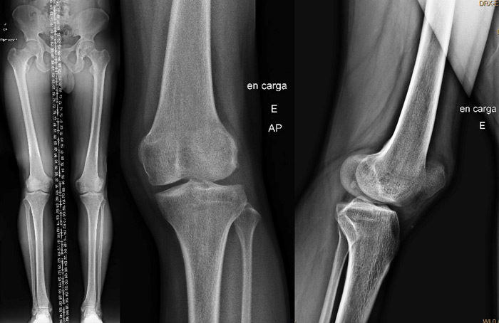 Pre-op X-rays