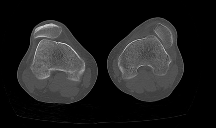 Pre op CT-scan