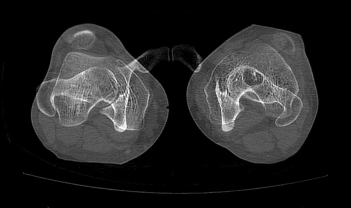 Pre op CT-scan