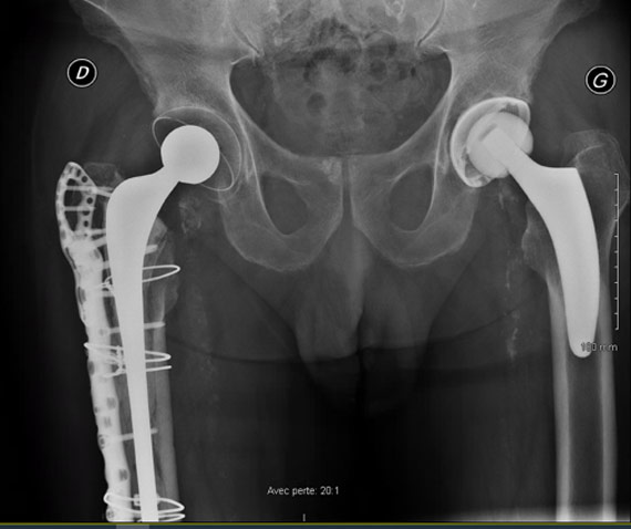 Peri prostetic femoral fracture - Postoperative imagery