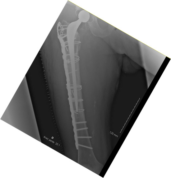 Peri prostetic femoral fracture - Postoperative imagery