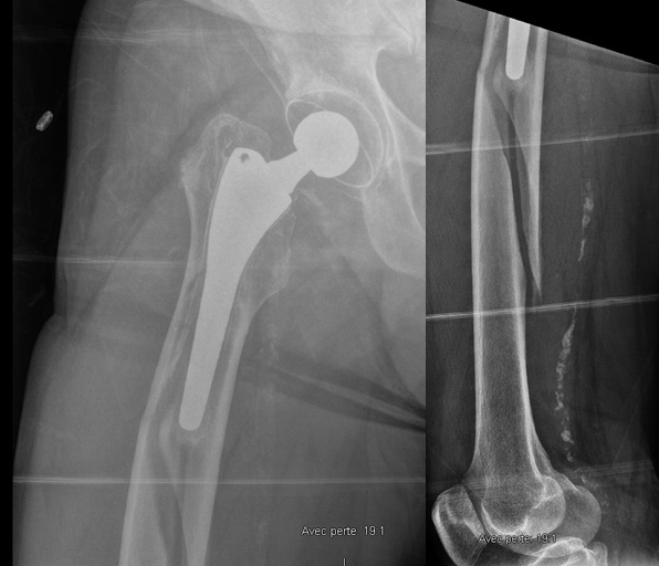 Management of a peri prostetic femoral fracture - Imagery