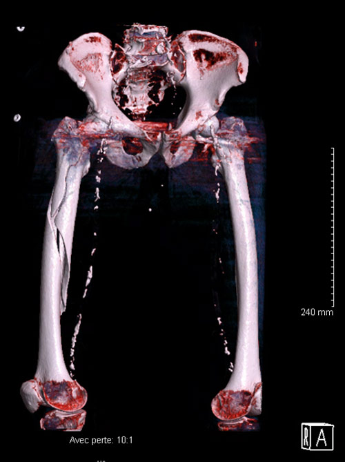 Peri prostetic femoral fracture - Imagery