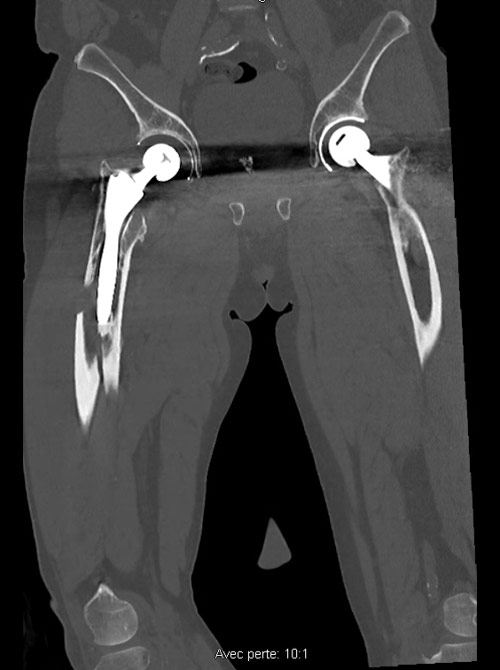 Peri prostetic femoral fracture - Imagery