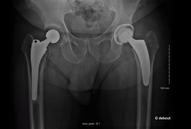 Peri prostetic femoral fracture - Previous X-rays