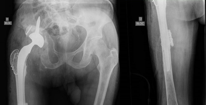 A hip revision with a stemmed cup 