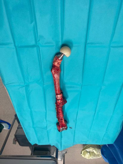 A 2 stage surgery was planed: 1st stage of ilio-tibial spacer then total femur.