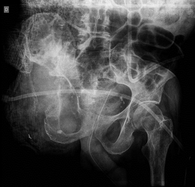 A Hip disarticulation was done one week later