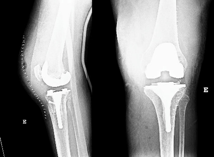 Patellar tendon avulsion after TKA