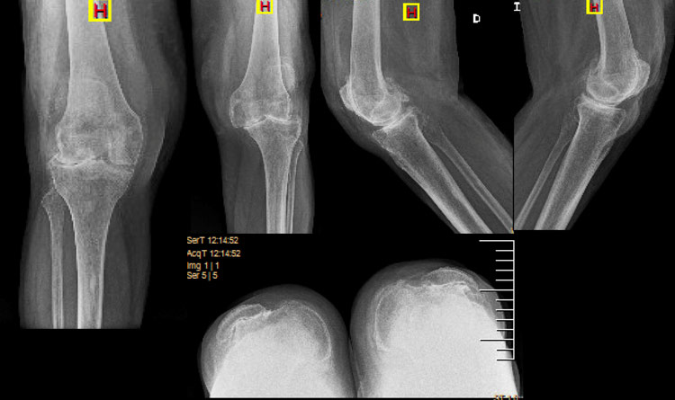 Patellar tendon avulsion after TKA