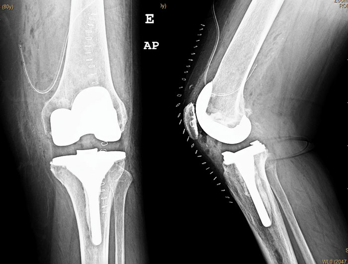 Patellar tendon avulsion after TKA