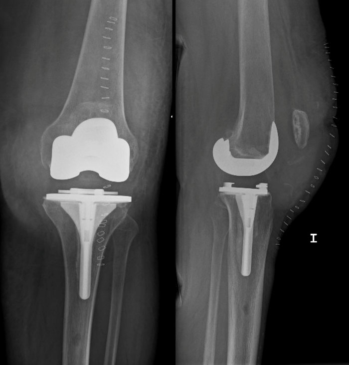 Patellar tendon avulsion after TKA