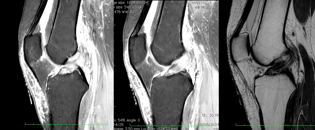 Type 2 ACL tear Van der List MRI classification