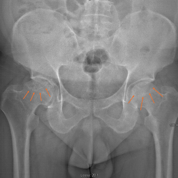 Femoral Head Avascular Necrosis