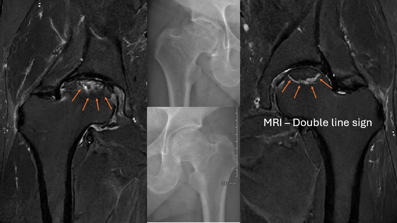 Femoral Head Avascular Necrosis