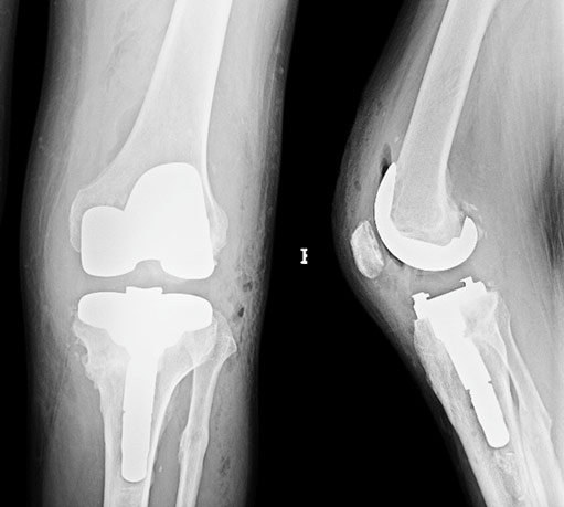 Post-op X-rays