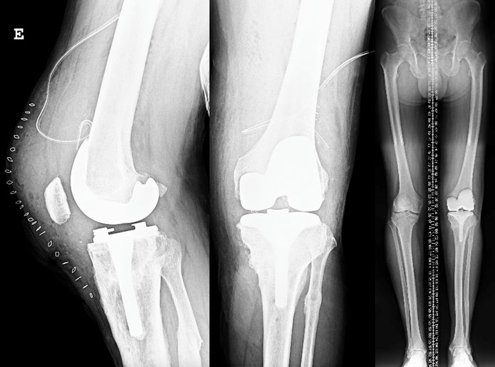 Post-op X-rays