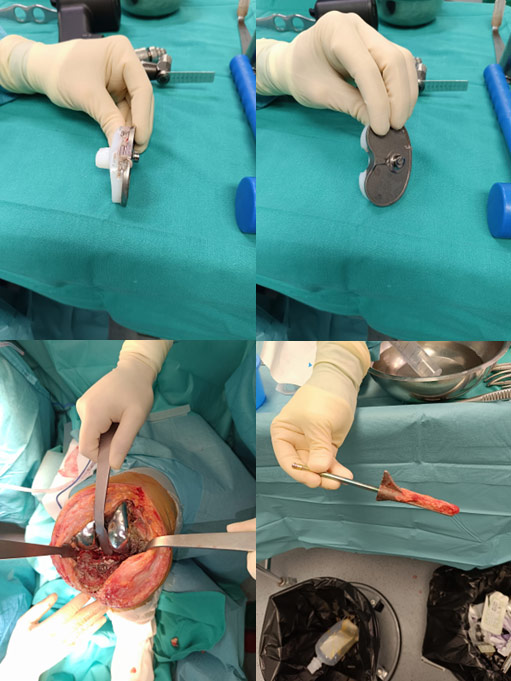 The tibial implant is found broken between the stem and the plate