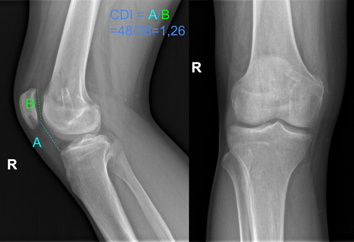 Management of a postoperative persistent patellofemoral instability in a young athlete