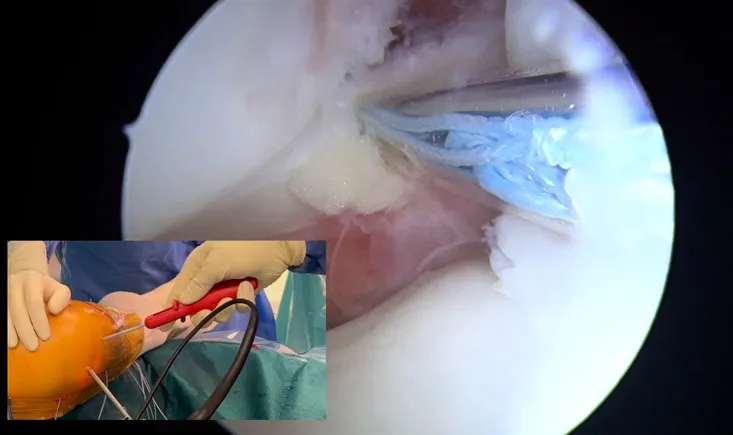 External meniscus root lesion treated with intra-articular fixation alone