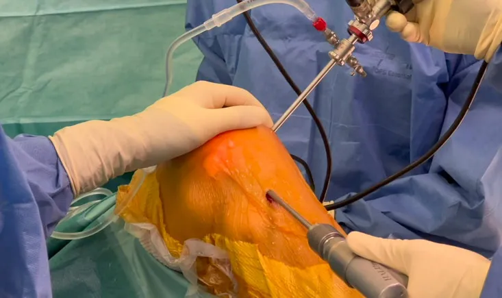 ACL remnant preservation using inside out femoral tunnel creation