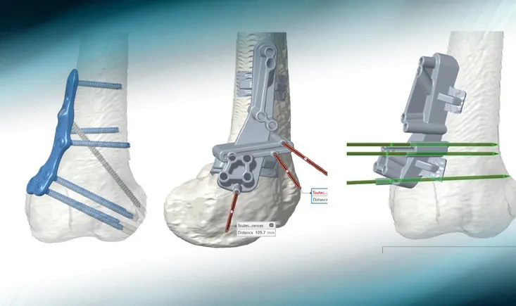 Management of an inveterate dislocation of the patella