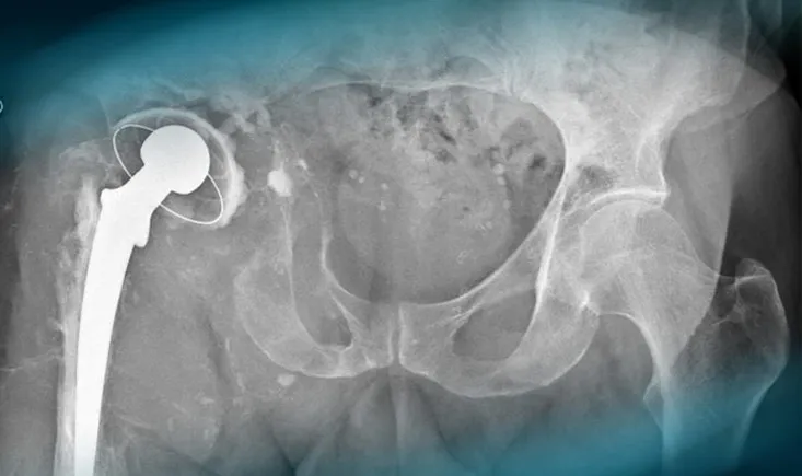 Complex hip revision in a patient with massive massive loss bone stock