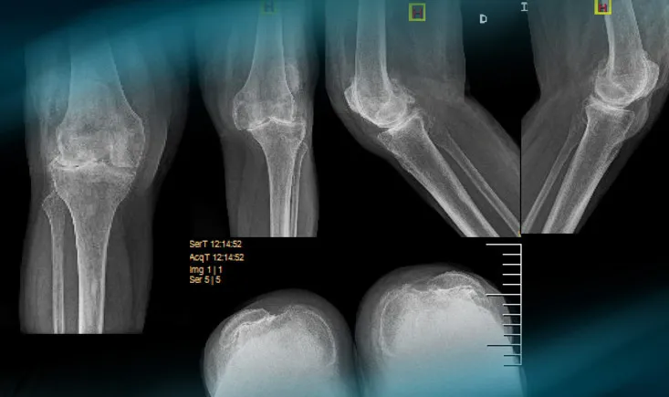 Management of a patellar tendon avulsion after TKA