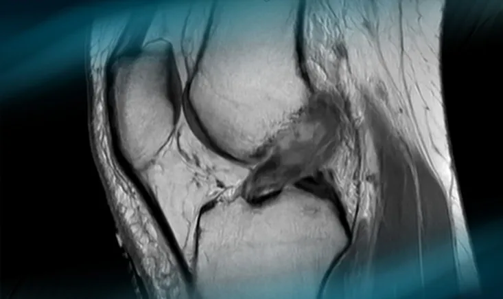 Acute ACL tear in a professional rower