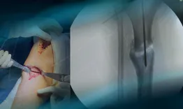 Post-traumatic knee pain: How to treat double varus deformity?