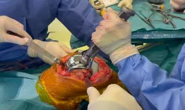 Uncemented total knee arthroplasty