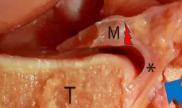 All about ramp lesions: In this slideshow, discover the anatomy, the epidemiology and the physiopathology of this type of lesion. Learn how to diagnose and treat them.