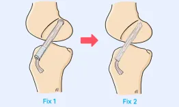 Biological failure of an ACL ligamentoplasty