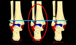 Periarticular lesions of the knee and ankle