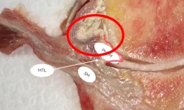 ACL and meniscal injuries