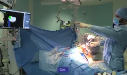 Functional positioning of a medial unicompartmental knee arthroplasty (UKA) with robotics