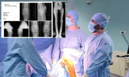 How to perform a Total Knee Arthroplasty (TKA) with robotic assistance