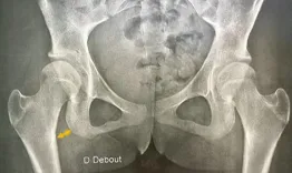 Hip preservation: Patient stratification- a bad candidate for preservation but a good candidate for TJA?