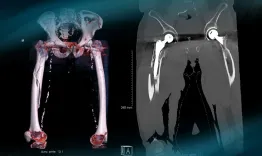 Management of a peri prostetic femoral fracture