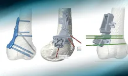 Management of an inveterate dislocation of the patella