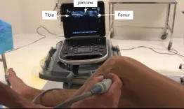 Minimally invasive ultrasound-guided anterolateral ligament reconstruction with autologous 2-strand gracilis graft