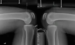 Posterior knee instability