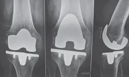 Alignment in TKA - State of art