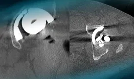 Management of a hip pain in a 51 year-old man with THA