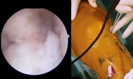 Remnant preserving ACL reconstruction - Scientific rationale and video technique