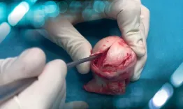 Femoral head avascular necrosis